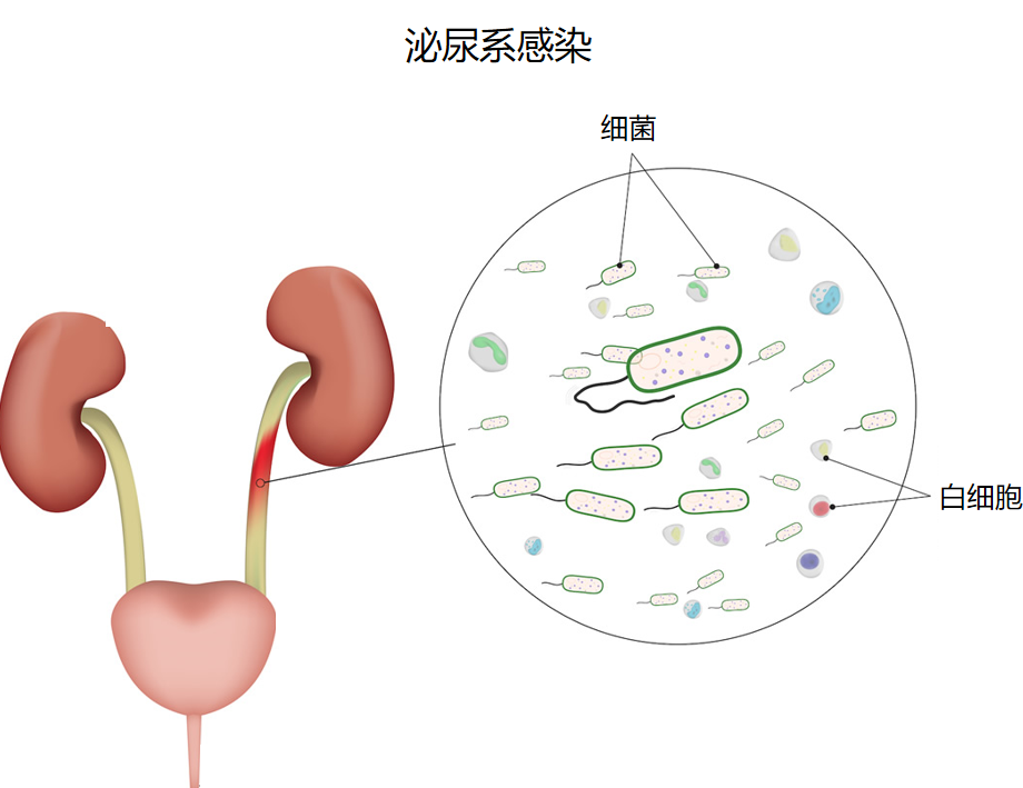 三伏天尿路結(jié)石的“高發(fā)季”，有哪些常見誤區(qū)