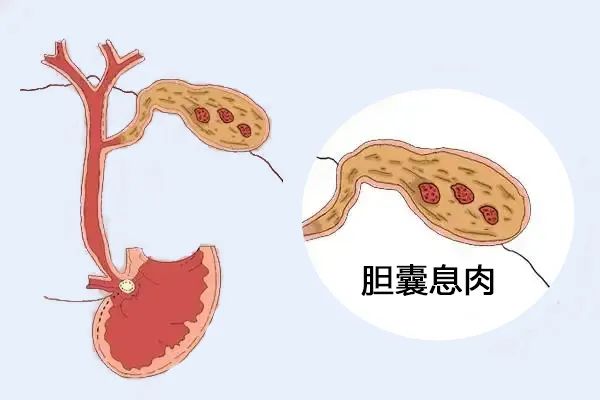 體檢出膽囊息肉，需要擔(dān)心嗎？