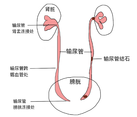 結(jié)石引發(fā)劇烈腎絞痛，該怎么辦？