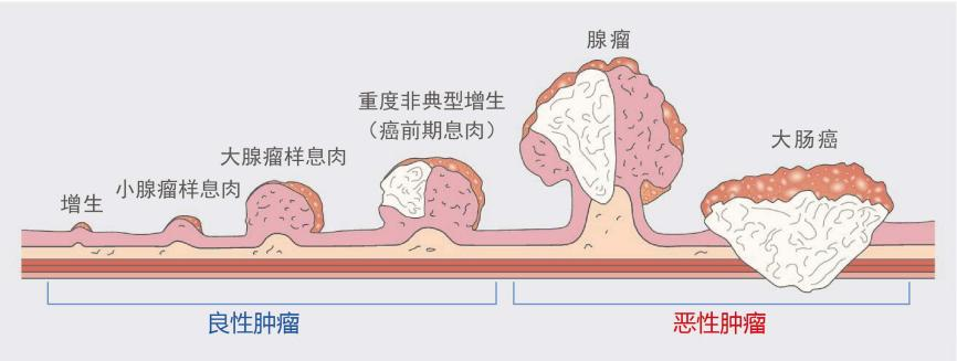什么樣的腸息肉容易癌變？有一種要特別當(dāng)心！