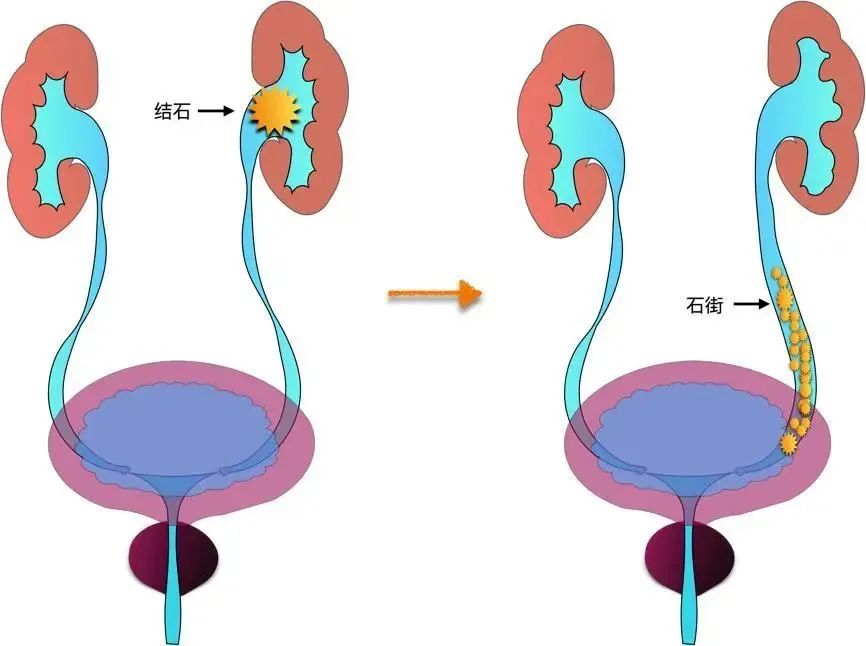 你經歷過腎絞痛嗎？該如何緩解治療？