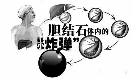 膽囊里的小結石要緊嗎？長大后再處理行不行？